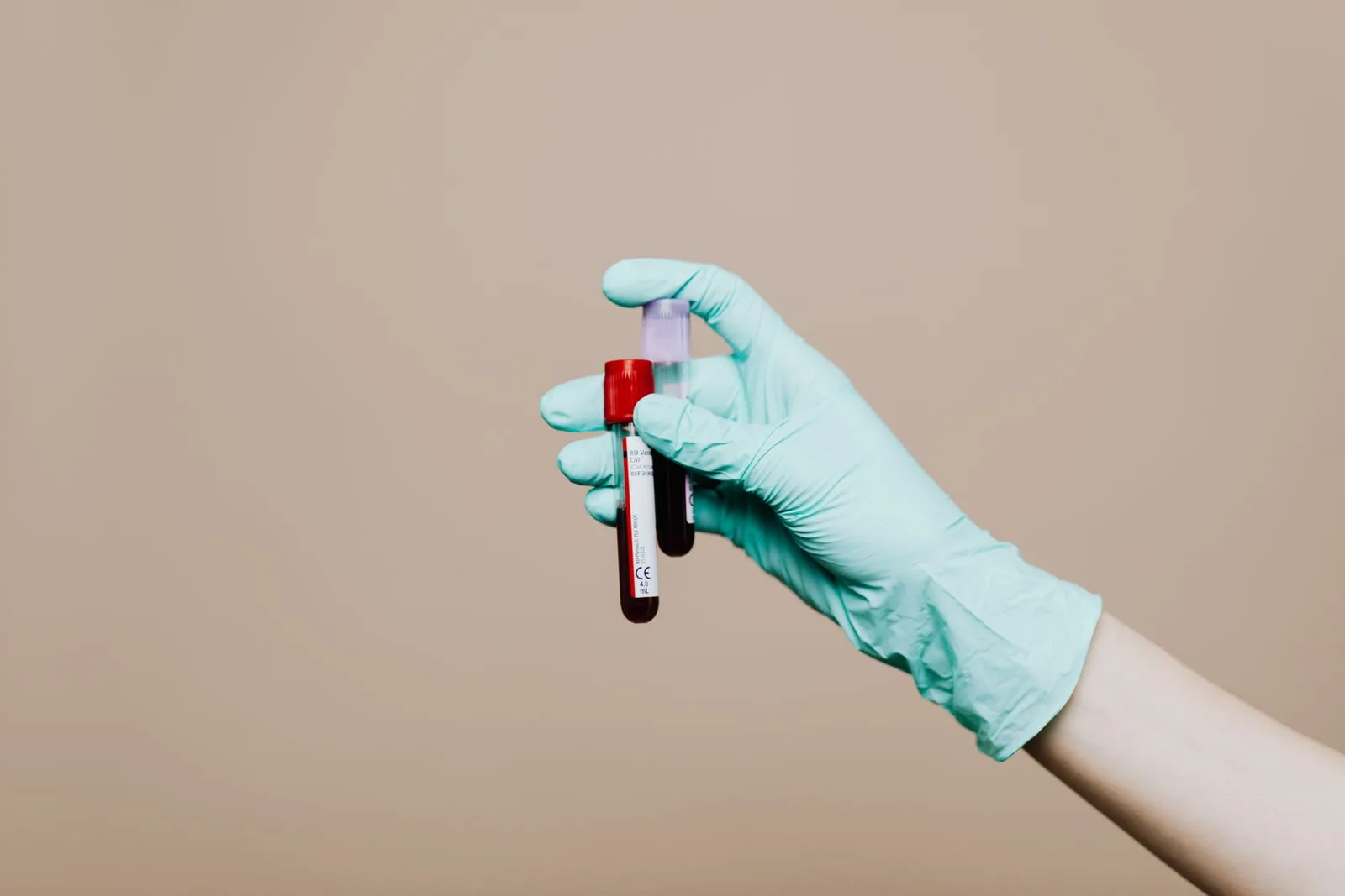 Gloved hand holding labelled blood test tubes for hair loss diagnosis